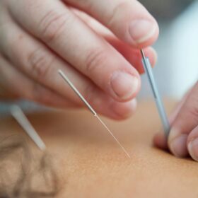 Acupuncture treatment Surrey